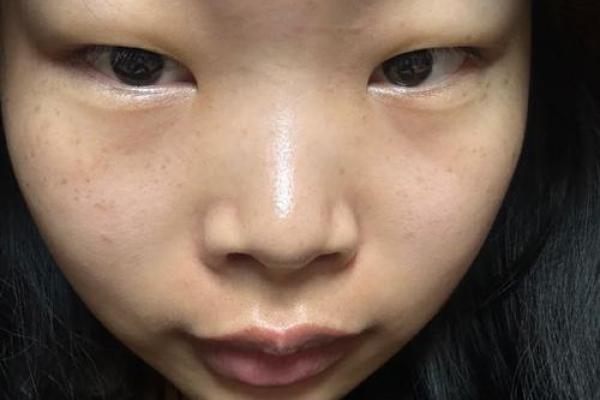 鼻子两侧八字纹图片