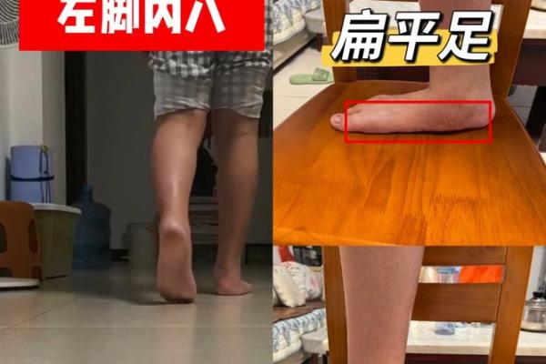 内八字腿型