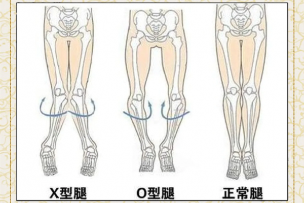 内八字、外八字孩子脚型正常不正常,家长可以这么判断 内八字、外八字孩子脚型正常不正常,家长可以这么判断