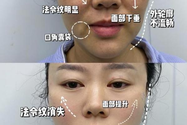 怎么消除八字纹