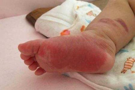 风水胎记胎记是红色的好吗危害