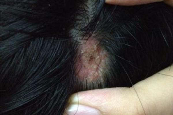 黑色胎记算命分析 黑色胎记算命分析