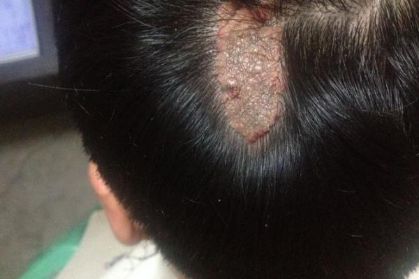 黑色胎记算命分析 黑色胎记算命分析