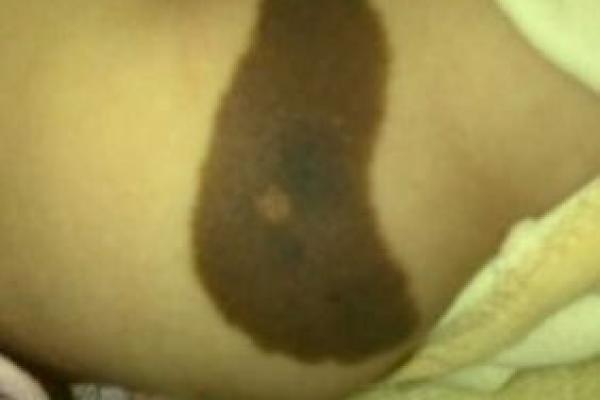 胳膊胎记算命 胳膊胎记算命