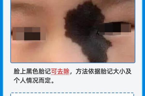 胎记算命：从胎记看运势
