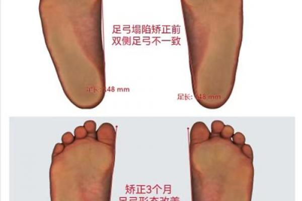 如何纠正内八字脚