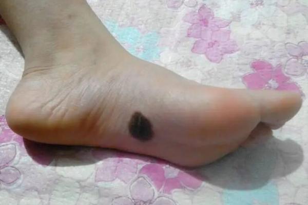 脚底的胎记算命分析