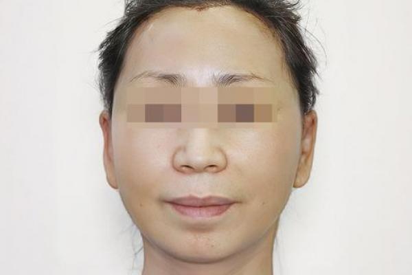 面部八字纹 面部八字纹