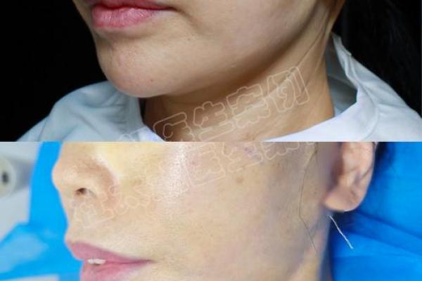 面部八字纹 面部八字纹